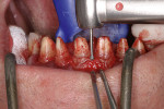 Figure 10 As the bony alveolar ridge should be repositioned apically with the lengthening of crowns, the bone was outlined with a diamond-coated tip and diamond-coated cutting tool.