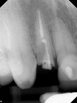 (2.) Periapical radiograph acquired at presentation confirming that, structurally, the tooth had a poor prognosis for restoration.
