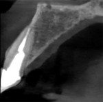 (3.) A cross section of a CBCT scan acquired 3 months prior to the tooth’s fracture permitted visualization of how thin the buccal plate was over the root.