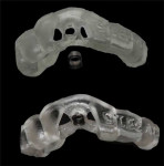 (7.) Views of the completed 3D printed surgical guide before and after the metal sleeve was luted into place.