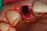 (12.) The lingual portion of the sectioned root was extracted, and the crestal aspect of the facial portion of the root was trimmed to lie apical to the gingival margin, completing the PET procedure.