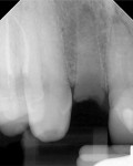 (13.) Postextraction periapical radiograph and small field of view CBCT scan views confirming that the site was ready for osteotomy.