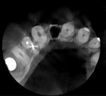 (14.) Postextraction periapical radiograph and small field of view CBCT scan views confirming that the site was ready for osteotomy.
