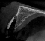(15.) Postextraction periapical radiograph and small field of view CBCT scan views confirming that the site was ready for osteotomy.