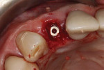 (20.) A cover screw was temporarily placed on the implant, and the gap was filled with an allograft material.
