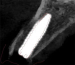 (21.) Postoperative CBCT scan of the implant with an overlay of the virtually planned implant position demonstrating that guided placement results in a position that very closely matches the virtually planned position.