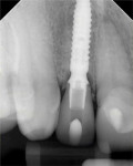 (23.) A final periapical radiograph was acquired to verify complete seating of the provisional restoration at the implant connector.
