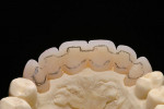 Figure 21  The long-term temporaries must be stable due to the length of time they are expected to be in the mouth. Therefore, a palatal metal strengthening structure was marked and synthetic bridge along the markings was trimmed, and the reinforceme
