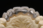 Figure 23  The long-term temporaries must be stable due to the length of time they are expected to be in the mouth. Therefore, a palatal metal strengthening structure was marked and synthetic bridge along the markings was trimmed, and the reinforceme