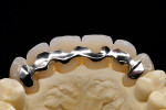 Figure 24  The long-term temporaries must be stable due to the length of time they are expected to be in the mouth. Therefore, a palatal metal strengthening structure was marked and synthetic bridge along the markings was trimmed, and the reinforceme