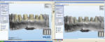 Figure 30  The frameworks were designed with a ZENOTEC CAD/CAM system in a partner laboratory. In order to be able to design and manufacture the frameworks in a manner that supports the function of the crowns, the milling center scanned the supplied