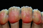Figure 44  Fluorescent dentin was then again applied to the dentin layer, which merged very delicately into the dentin.