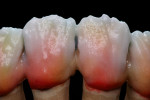 Figure 45  Before application of the enamel and incisal layers, a transparent intermediate layer was created by covering the dentin layer in a thin coat made from Transpa Neutral.