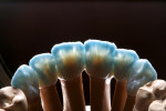 Figure 50  Enamel material was applied in the palatal area with the addition of some Opal Incisal in the incisal area.