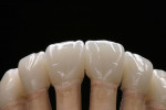 Figure 10   Two hollows meet in a cervical direction. These hollows support the torsion of the tooth and ensure that the vestibular surface does not emerge from the gum in a rounded fashion, but rather flat.