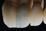 Figure 67   It is important that these growth striations run around the whole of the body of the tooth. This is because these lines survive to be stronger in the protected areas than those in the areas that are more active.
