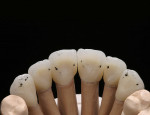 Figure 69: After the form and the surface of the artificial teeth had been processed, the occlusion and the function of the teeth were addressed. In the articulator, the centric stops on the palatal bulges were marked with black occlusion foil.