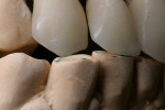 Figure 70  Through the development of the function of the teeth, the esthetic qualities were also refined. As appropriate free space is created at the incisal edges, the typical tooth shape was refined at the same time and therefore improved the esth