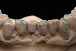Figure 73   The previously indicated excursion movements can be carried out on the crowns secured with Tac Gel and displayed with appropriately colored occlusion foil.