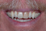 Fig 1. Preoperative, frontal view. The patient’s chief concern was the need for restorations at the gingival margins of the upper cuspids and bicuspids, where he had a high smile line. He would address the discolored central incisor at a later time.