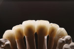 Figure 80  In transmitted light, the warm and bone-like character of the full-porcelain crowns becomes clear.