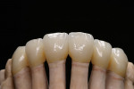 Figure 81  In reflected light on the sectioned model, the zirconium-dioxide-based crowns also look very natural.