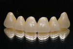Figure 82  The finished crowns were once again photographed on the reflector so that the light qualities of the translucent zirconium dioxide and ZIROX veneering porcelain duo were better emphasized.