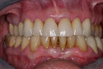 Figure 90  At a check-up a few weeks later, it could be seen that the gingiva had already healed well and regenerated.
