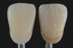 Figure 2  The stains adapt perfectly to resins, composites, acrylic teeth, prefabricated teeth, or PMMA structures.