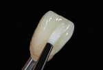 Figure 8  The anatomic, pre-formative shaping of the individualized surfaces can be realized with a flat brush.
