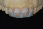 Figure 1  The use of ceramic effects built into the incisal third help to allow the restoration to blend into the oral environment.
