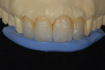 Figure 2  Using an index provides guidance for building effects and incisal placement.