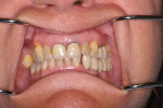 Figure 3  The patient’s preoperative situation can determine the need for improvement in the final restorations.