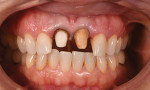 Fig 1. Case 1, tooth preparations Nos. 8 and 9.