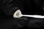 Fig 3.
Zirconia primer was applied to the intaglio surface of the crowns.