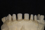 Figure 6  Today, ceramic margins are most often prescribed to allow light into the root area and help deliver the desired optical properties.