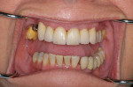Figure 9: The rough bisque-bake restorations are tried in for fit and esthetics.