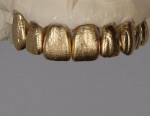 Figure 12  The use of gold or silver powder helps show tooth texture and defines the shape.