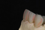 Figure 13  Tissue casts help  establish the proper  emergence profile.