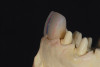Figure 5  Preoperative retracted left lateral view of the dentition.