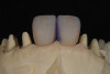 Figure 6  Preoperative retracted view of the dentition.