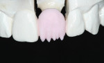 Figure 5  Facial porcelain is applied to match the porcelain previously placed on the lingual surface.