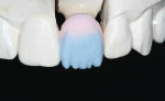 Figure 10  Facial incisal porcelain is applied to match up with the previously applied lingual porcelain.