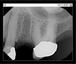 Fig 9. Periapical radiograph,
socket after bone grafting of site No. 13.
