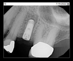 Fig 19. Periapical radiograph showing final implant placement.