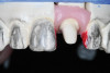 Figure 31  Etch was applied to teeth Nos. 8 and 9.