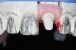 Figure 21  Rubbing adjacent teeth on the working model with carbon from an indelible pencil helps define the desired surface texture.