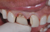 Figure 44  Postoperative portrait of the patient and his new smile. Note the natural tooth-like appearance of IPS e.max restorations.