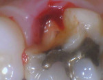 (1.) Preoperative photograph of the patient’s fractured maxillary right first molar.