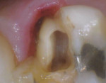 (2.) Close-up view following root canal therapy.